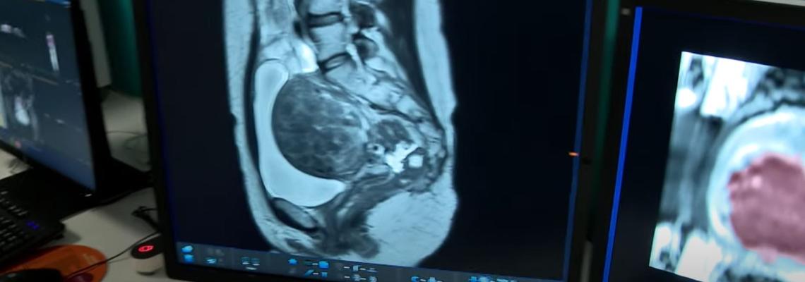 CHPG : Nouveau système de traitement des fibromes utérins
